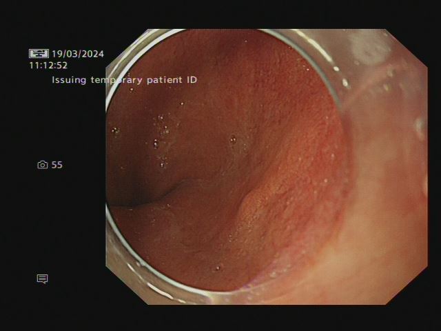 Endoscopic photo of the surface of the oesohagus