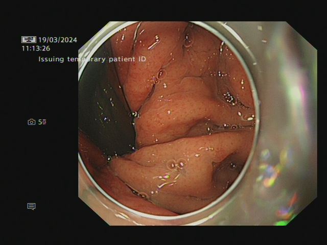 Photo of the oesophageal sphincter from the endoscope