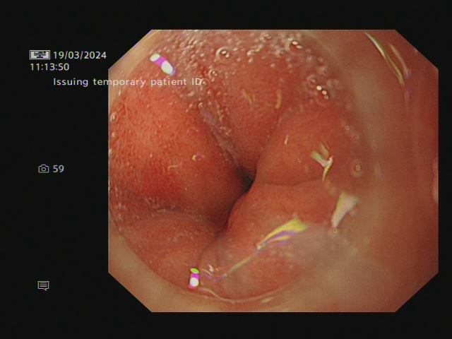 photo of the oesophagogastric junction.
